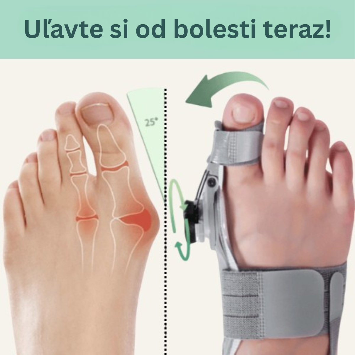 Liečebný balík na vybočený palec (Hallux Valgus)
