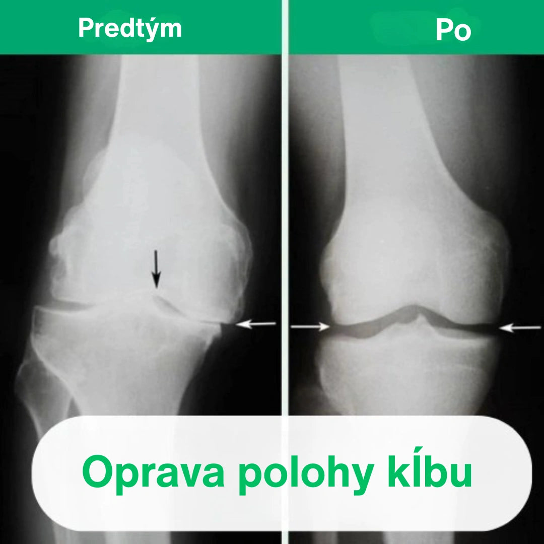 OrthoKnee™ – Dlhodobá úľava od artritídy a bolestí kĺbov