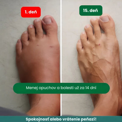 Zenstride® Priedušné kompresné ponožky pre nohy a chodidlá bez bolesti